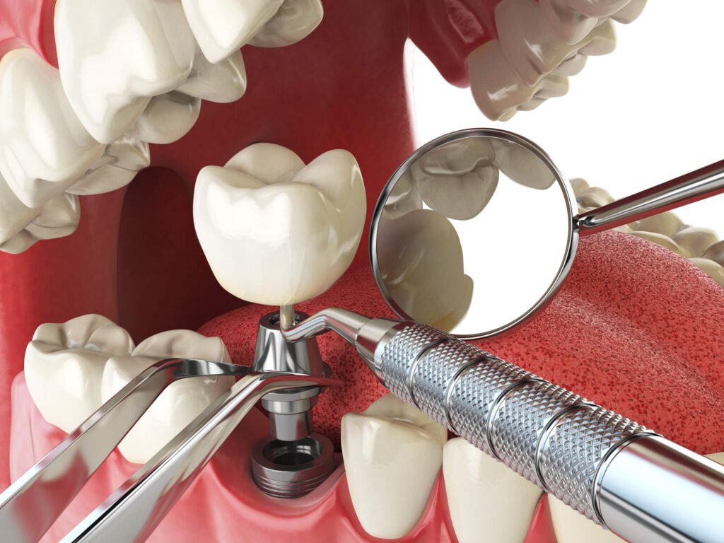 dental implants diagram troy mi